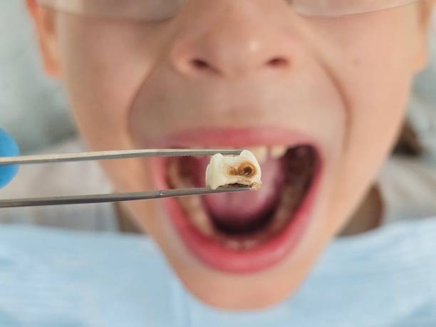 Best Emergency Tooth Extraction in High Springs, FL